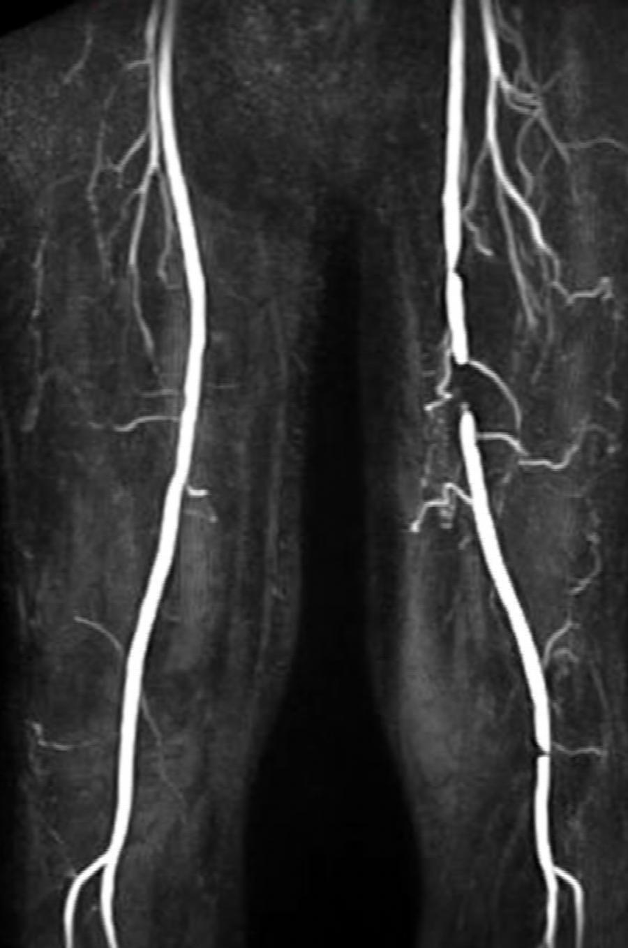 Patient: kurzer Verschluss AFS links; MRA; vorher
